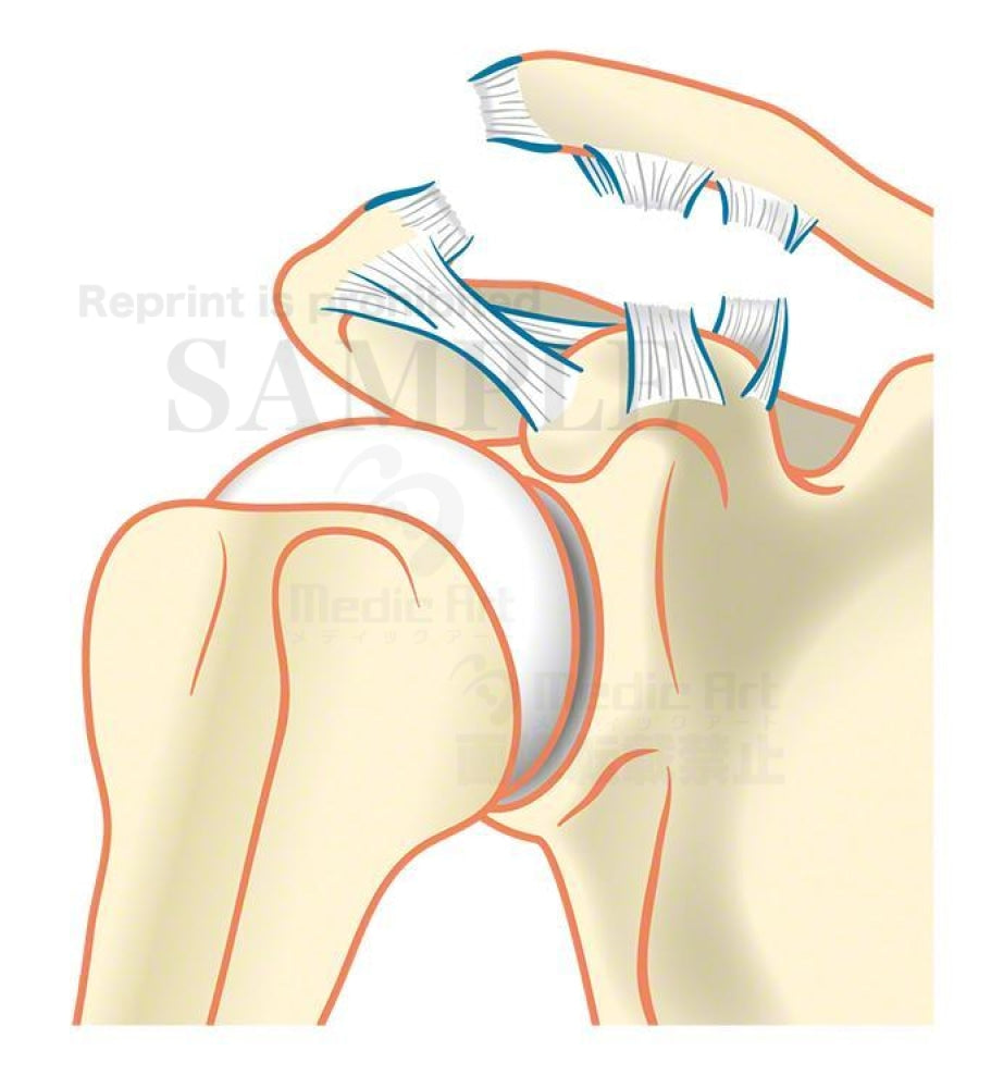 Acromioclavicular joint dislocation