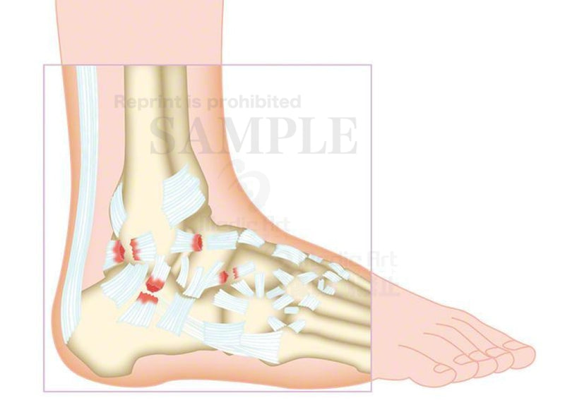 Sprain (sprain: ligament damage of the external foot)