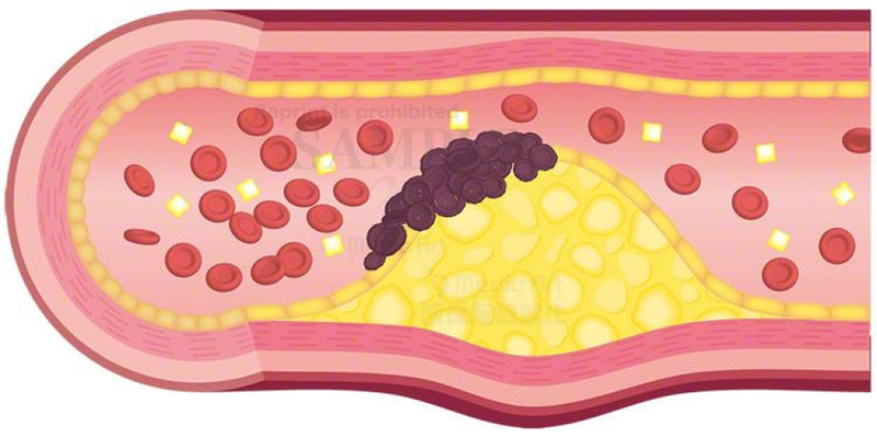 血管の壁にコレステロールが蓄積している様子