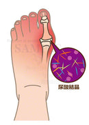 痛風発作を起こしている足（尿酸結晶のイメージ図付）