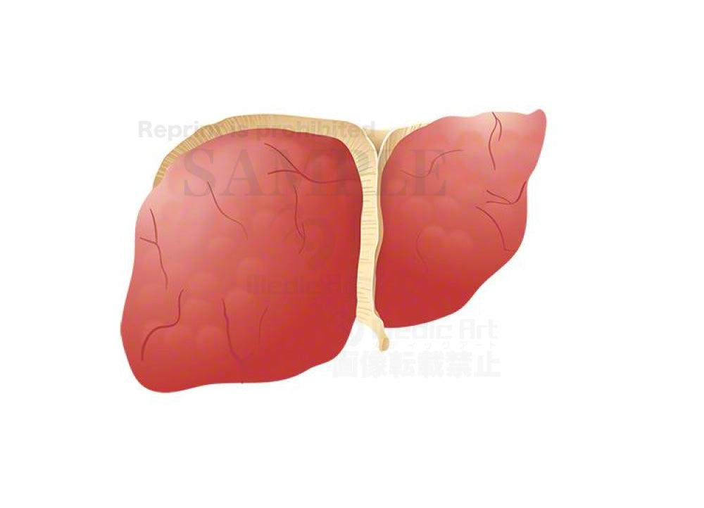 Cirrhosis of the liver(Enlarged focus of disease)　