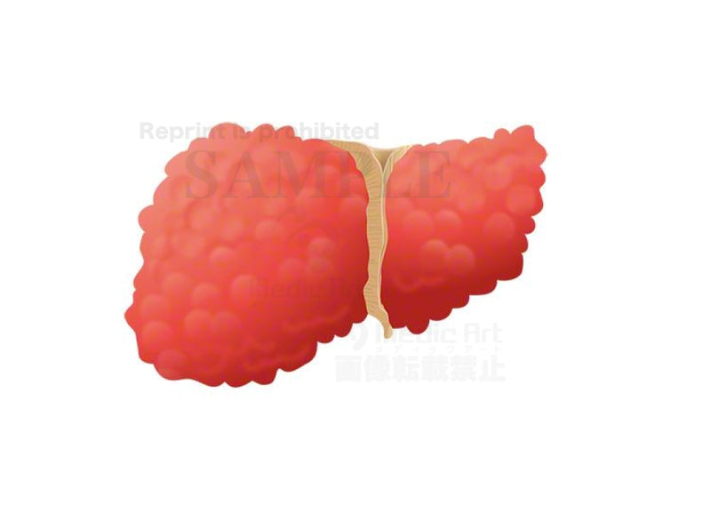 Cirrhosis of the liver　