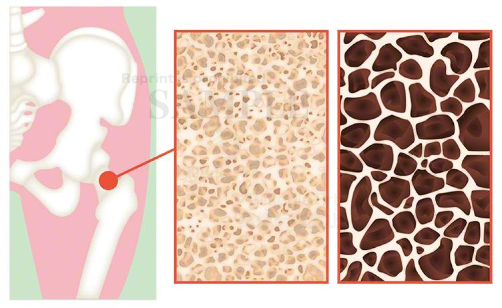 Osteoporosis