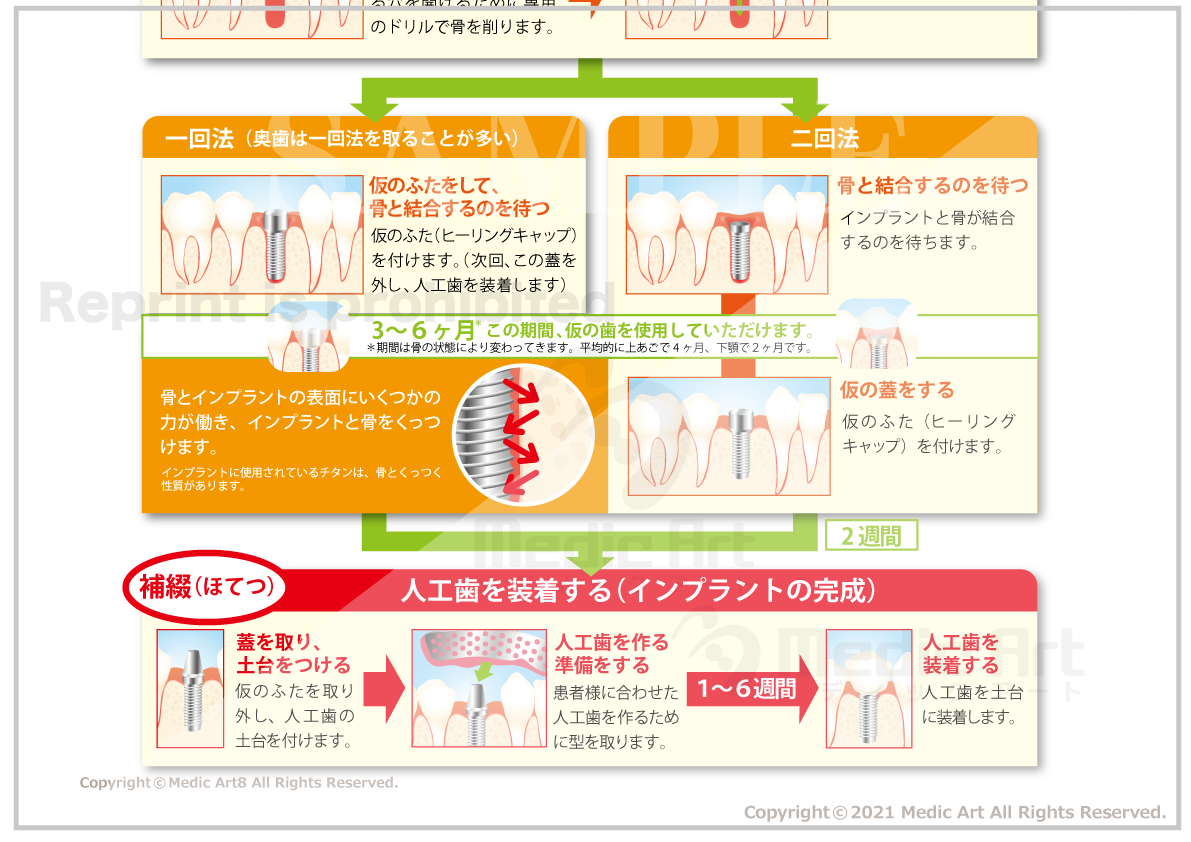 インプラント施術の流れ ［シート］