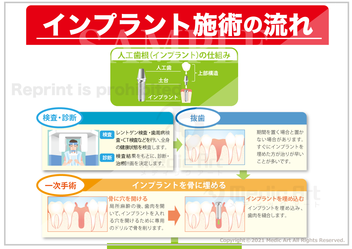 インプラント施術の流れ ［シート］