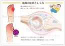 痛風の症状としくみ ［シート］