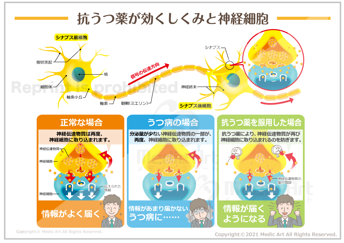 抗うつ薬(SSRI:セロトニン再取り込み阻害薬)が効くしくみと神経細胞 ［シート］