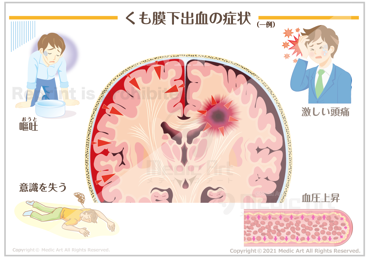 くも膜下出血の症状 ［シート］
