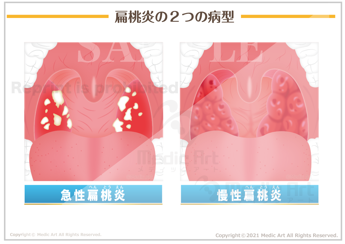 扁桃炎の２つの病型 ［シート］