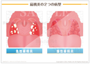扁桃炎の２つの病型 ［シート］