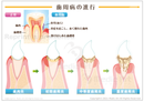 歯周病の進行 ［シート］