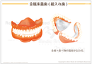 金属床義歯（総入れ歯） ［シート］
