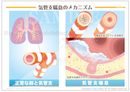 気管支喘息（ぜんそく）のメカニズム ［シート］