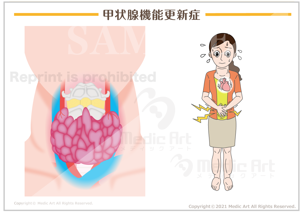 甲状腺機能更新症［シート］