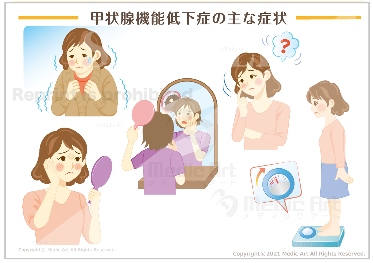 甲状腺機能低下症の症状［シート］