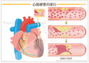 心筋梗塞のイメージ［シート］