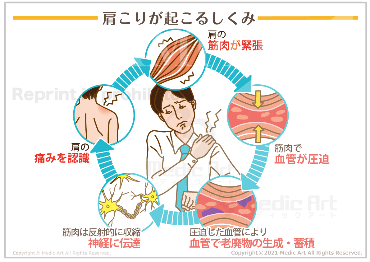 肩こりが起こるしくみ［シート］