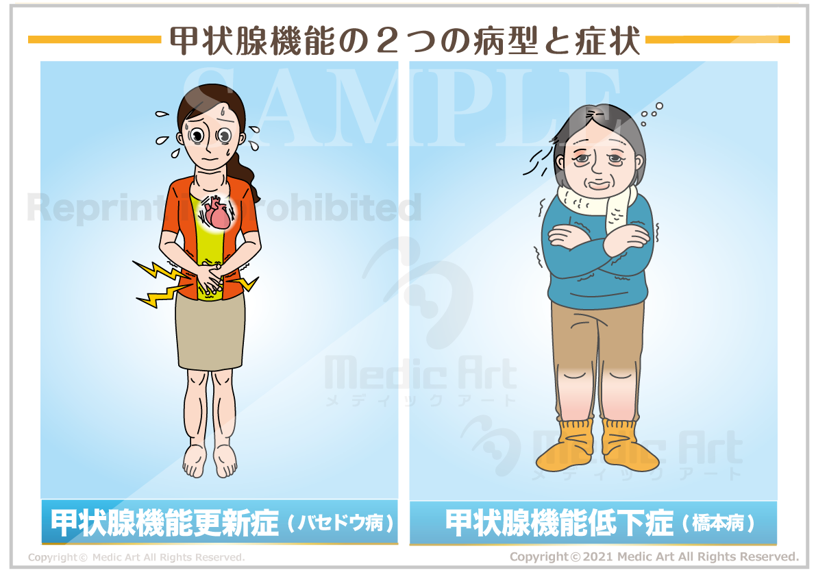甲状腺機能の２の病型と症状［シート］