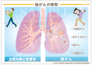 肺がんと正常な肺 ［シート］