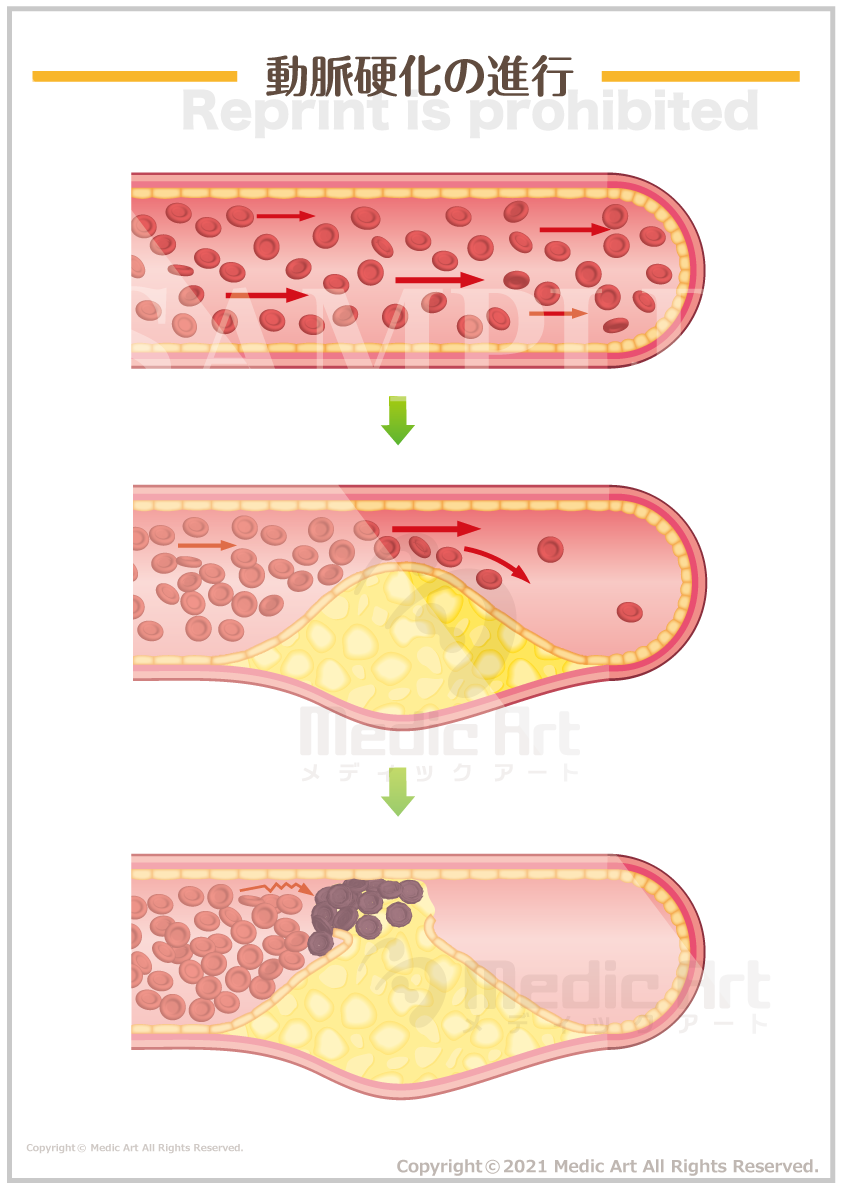 動脈硬化の進行 ［シート］