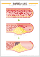 動脈硬化の進行 ［シート］