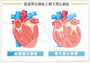 拡張型心筋症と肥大型心筋症 ［シート］