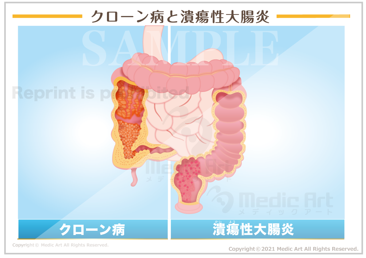 クローン病と潰瘍性大腸炎［シート］