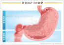 胃炎症の２つの病型［シート］