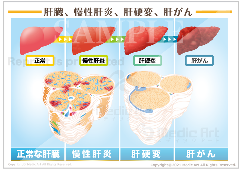 肝臓、慢性肝炎、肝硬変、肝がん［シート］