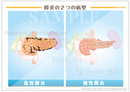 膵炎の２つの病型［シート］