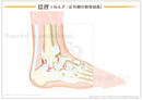 捻挫(ねんざ:足外側の靭帯損傷)［シート］