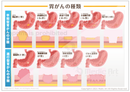 胃がんの種類［シート］