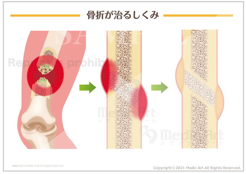 【外傷】骨折が治るしくみ ［シート］