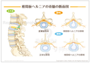 【骨・関節の病気】椎間板ヘルニア ［シート］
