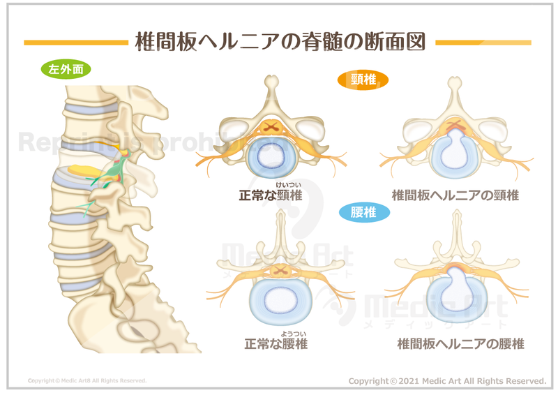 【骨・関節の病気】椎間板ヘルニア ［シート］