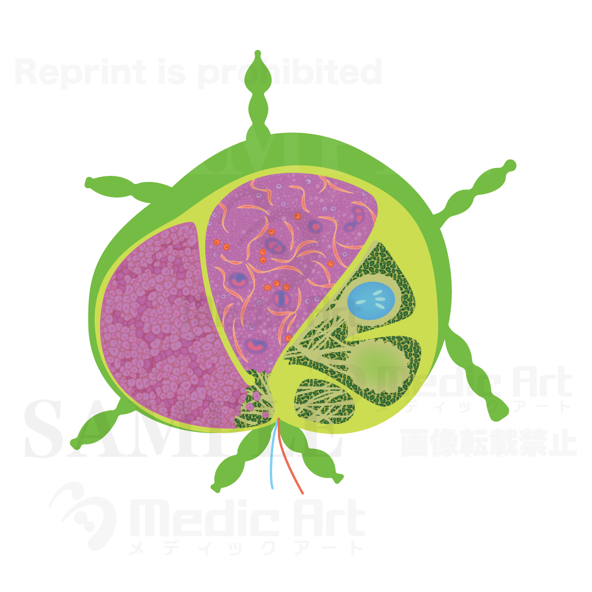 Malignant lymphoma (Hodgkin's lymphoma)