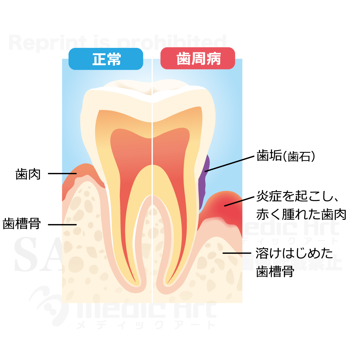 Comparison of normal teeth and periodontal teeth[with Japanese characters]